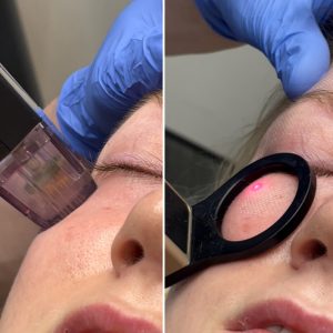 Grace undergoes CO2 laser Morpheus8 combination skin tightening treatment by Dr Joshua Van der Aa