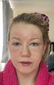 Patient after treatment laser and Morpheus8 by Dr Joshua Van der Aa