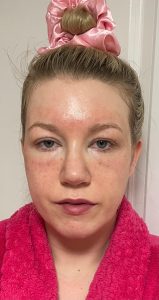 Patient after treatment by Dr Joshua Van der Aa