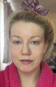 Patient after treatment by Dr Joshua Van der Aa